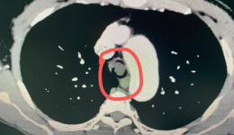 自治区南溪山医院支气管硬镜术突破“一线天”困境，为患者撑开“呼吸之门”