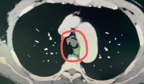 自治区南溪山医院支气管硬镜术突破“一线天”困境，为患者撑开“呼吸之门”