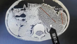 3岁萌娃梗阻危机解除：机器人手术助力，无缝衔接回园学习