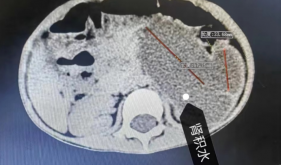 3岁萌娃梗阻危机解除：机器人手术助力，无缝衔接回园学习