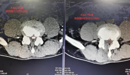 腰腿疼痛久治不愈？微创技术助力患者重获轻松行走！自治区南溪山医院疼痛科运用脊柱内镜技术精准治疗腰椎疾病