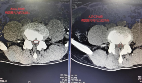 腰腿疼痛久治不愈？微创技术助力患者重获轻松行走！自治区南溪山医院疼痛科运用脊柱内镜技术精准治疗腰椎疾病