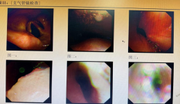 硬镜护航生命通道！广西壮族自治区南溪山医院成功为复杂肺癌患者实施气道支架植入术