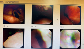 硬镜护航生命通道！广西壮族自治区南溪山医院成功为复杂肺癌患者实施气道支架植入术