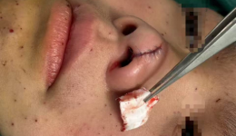 男童被鞭炮炸伤脸颊 医生提醒：烟花虽美 小心有“炸”