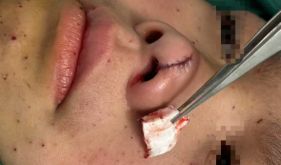 男童被鞭炮炸伤脸颊 医生提醒：烟花虽美 小心有“炸”