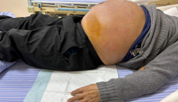 自治区南溪山医院运用腹水超滤浓缩回输技术为患者撑起“无忧”生命的希望