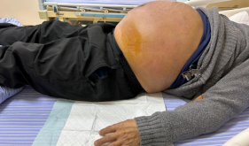 自治区南溪山医院运用腹水超滤浓缩回输技术为患者撑起“无忧”生命的希望