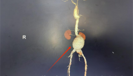七旬老人反复血便，自治区南溪山医院血管外科团队拆除“定时炸弹”