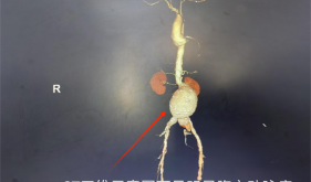 七旬老人反复血便，自治区南溪山医院血管外科团队拆除“定时炸弹”