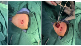 精准呵护，无痕关爱 自治区南溪山医院整形外科成功为4月龄婴儿实施超减张缝合血管瘤精准切除