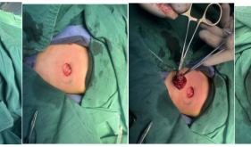 精准呵护，无痕关爱 自治区南溪山医院整形外科成功为4月龄婴儿实施超减张缝合血管瘤精准切除