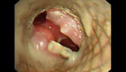 勇闯生命禁区—自治区南溪山医院成功实施一例高难度气道支架置换术