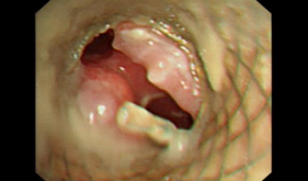 勇闯生命禁区—自治区南溪山医院成功实施一例高难度气道支架置换术