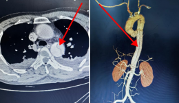 生死时速！自治区南溪山医院成功救治一位主动脉夹层破裂患者