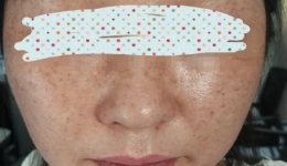 皮肤‘诡异发黑’求医 自治区南溪山医院专家揭祕：解毒变中毒！