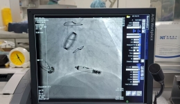 自治区南溪山医院成功应用无导线心脏起搏器 为高危抗凝患者重启生命律动