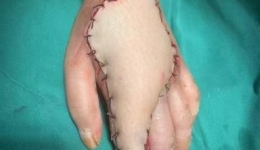 自治区南溪山医院烧伤整形与创面修复外科成功救治蛇咬伤患者