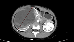 妈妈摸出的10厘米肿瘤！自治区南溪山医院运用机器人手术成功切除儿童巨大肾脏肿瘤
