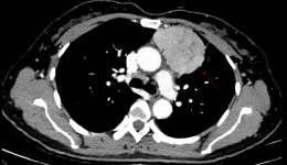 自治区南溪山医院胸外科完成多例机器人辅助胸腺瘤手术