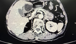 突破技术壁垒！自治区南溪山医院成功完成首例腹腔镜下顺行性模块化胰体尾+脾脏切除手术