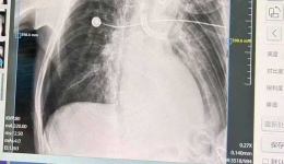 “物“入“气“途，有”镜“无险：自治区南溪山医院团队支气管硬镜术巧取异物解除病痛
