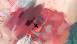 自治区南溪山医院神经外科成功开展桂林首例颈7神经移植手术