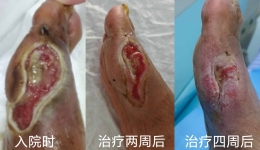 自治区南溪山医院三强联合成功“保脚”破局“腿梗”免截肢