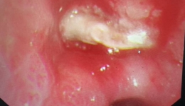 久咳不愈真凶竟在气道 “潜伏”异物终被南溪山医院专家精准擒获 ——七旬老人反复咳嗽、气喘一年多，镜下取出异物效果立竿见影