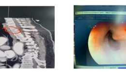 小小鱼刺酿凶险 内镜微创解危机 自治区南溪山医院消化内科成功救治食管异物致食管脓肿患者