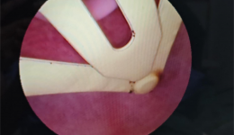 辗转求医五月未愈 南溪山医院微创技术助女童取出阴道异物康复