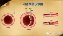 比心梗还致命？死亡率超50%的“血管撕裂”！自治区南溪山医院心脏大血管外科助偏瘫老人重获新生
