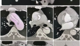 麻将桌上突发胸痛，9小时生死竞速—— 自治区南溪山医院成功救治40岁男子主动脉夹层男子