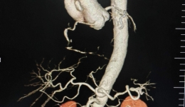 复合手术破危局 妙手仁心护新生——自治区南溪山医院攻克疑难危重心血管疾病彰显硬核实力